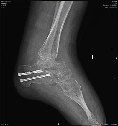 Lateral foot radiograph showing correction of the deformity after calcenus osteotomy.