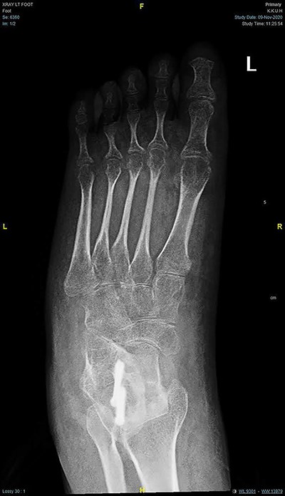 AP radiograph of the foot showing corrected for foot adduction.