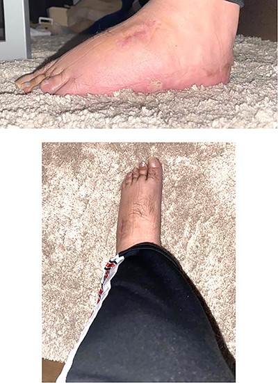 Side and front photo for the left lower limb postoperative (after 6 months).