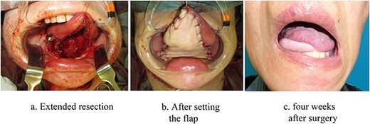 Intraoral image of Case 1. (a) Extended resection. (b) After setting the flap. (c) four weeks after surgery.