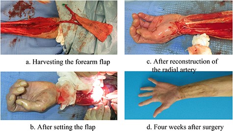 Left forearm image of Case 1. (a) Harvesting a forearm flap. (b) After setting the flap. (c) After reconstruction of the radial artery. (d) Four weeks after surgery.