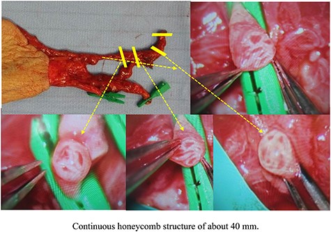 Image of the left forearm flap harvested in Case 2. Continuous honeycomb structure of about 40 mm.