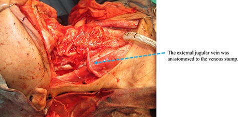 Image of the right neck recipient area of Case 2. The external jugular vein was anastomosed to the venous stump.