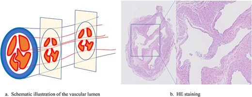 Vascular lumen of the drainage vein in Case 2. (a) Schematic illustration of the vascular lumen. (b) HE staining.