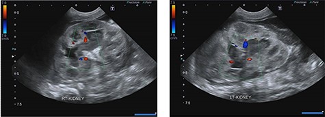 Ultrasonography shows echogenic lesions in dilated renal pelvis and calyces, bilaterally.