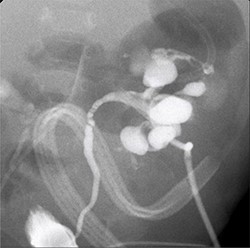 Antegrade pyelography; filling defect in the left kidney and contrast extravasation at the upper and lower pole.