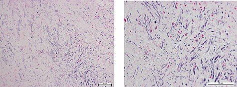 Pathological diagnosis report of fungal balls, consisting of Candida spp.