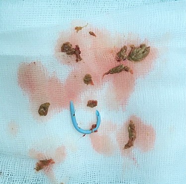 Extracted fungal ball.