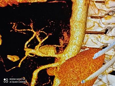 3D dimensional CT angiography shows CAA before intervention.