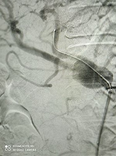 Angiography revealed large CAA.