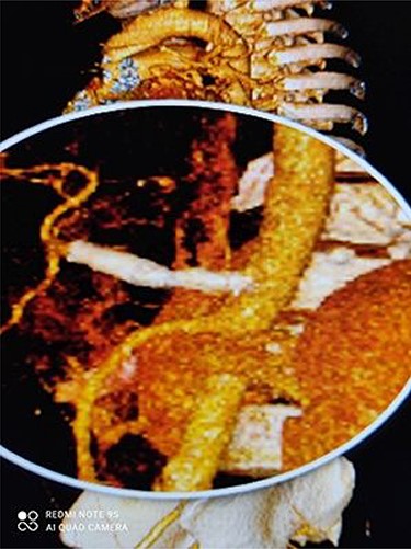 3D dimensional CT angiography shows CAA after intervention.