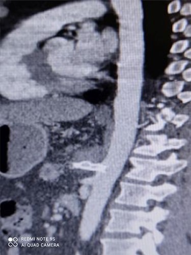 CT angiography showing repaired CAA with no leakage.
