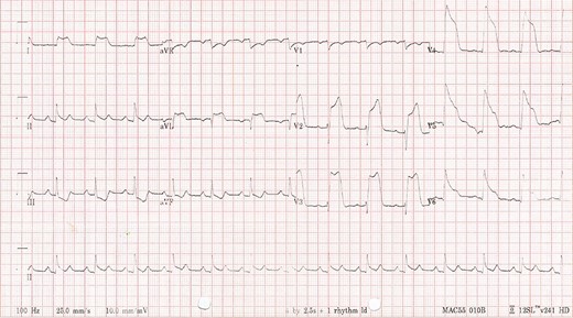 Patient’s electrocardiogram day one of admission demonstrating anterior ST elevation myocardial infarction with reciprocal ST-T wave changes in the inferior leads.