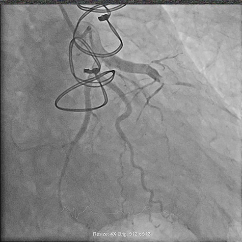 Coronary angiogram demonstrating proximally occluded LAD artery.