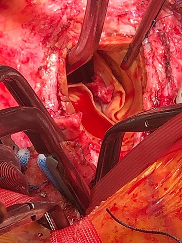 Endocarditic lesion on the ventricular surface of the non-coronary cusp of the bioprosthetic valve during revision of Bentall’s procedure.