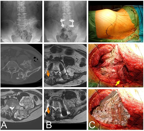 Chondrosarcoma in the sacrum of a 44-year-old male. A plain radiograph (A, top) and CT (A, middle) shows an osseous lesion in the sacrum. The osseous lesion is covered by a cartilaginous lesion with a high signal T2 weighted image (A, bottom). L5 and S1 were fused with screws in the initial operation (B, top). Eleven months after the initial operation cartilaginous nodules appear as a recurrent lesion at L5 (B, middle) and S1 (B, bottom). The once elevated distal multifidus muscle on the non-tumor side was morphologically almost normal (orange arrows), but the distal multifidus muscle on the tumor side was still thin. The patient was in the right-side bottom decubitus position. The skin marker shows the convex skin incision at the distal sacrum posteriorly (C, top). The sacrum is viewed by retraction of the multifidus muscle (yellow arrow) (C, middle). The image of the sacrum is overlapped on the C-middle picture to show the anatomical location (C, bottom).