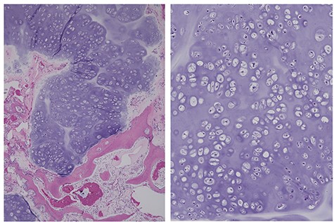 The same case as in Fig. 1, diagnosed as a chondrosarcoma. The resected recurrent tumor has a nodular structure with cartilaginous matrix. A permeative pattern is observed (left). The magnified view shows dense chondrocytes (right).