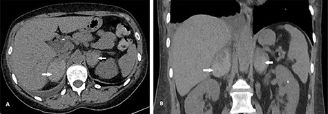 CT scan showing axial (A) and coronal (B) views of BAH (arrows). The right adrenal hemorrhage measured 35 × 52 mm axially and the left adrenal hemorrhage measured 40 × 33 mm.