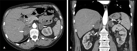 CT scan after 6 weeks showing axial (A) and coronal (B) views of resolving BAH (arrows). The right adrenal hemorrhage now measures 30 × 46 mm axially and the left adrenal hemorrhage measures 33 × 28 mm.
