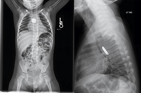 Chest X-ray demonstrated a radiopaque foreign body with halo sign on AP and step-off on lateral view concerning for button battery.