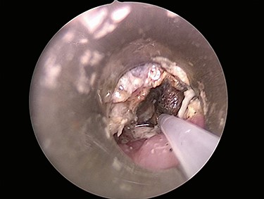Initial esophagoscopy showing the distal esophagus with near circumferential mucosal injury, sparring the posterior esophageal wall. The injury penetrated through the mucosa into the muscular layer.