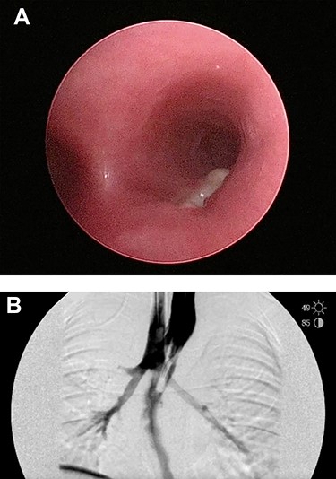 (A) Repeat bronchoscopy shows a broncho-esophageal fistula on the posterior wall of the right mainstem bronchus just past the carina. (B) Esophagram was performed while in the operating room and clearly shows the fistula to the right mainstem.