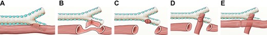 (A) Broncho-esophageal fistula shown at posterior right mainstem bronchus. (B) The esophagus was transected above and below the area of the fistula with a small rim of muscular esophagus left on the bronchus side of the fistula. (C) The mucosa of this short segment was resected and then this area was closed over the fistula track using a series of 5–0 PDS sutures. (D) Intercostal muscle flap secured over the fistula repair using 5–0 PDS suture tails that were left in place from the prior closure. (E) Completed esophageal anastomosis.