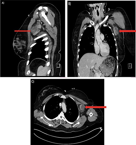 There are multiple enhancing soft tissue lesions involving the left axilla, the largest measuring 4.0 × 3.5 × 4.3 cm and 2.3 × 2.2 × 2.3 cm in maximal AP (A), Sagittal (B) and Coronal (C) Axial, with the largest lesion demonstrating internal necrosis and adjacent infiltrative changes.