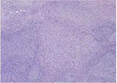H&E slide (low magnification, 4×) shows characteristic paracortical zonal process involving part of a lymph node. Background consists of preserved nodal architecture with a follicular center and a mantle zone adjacent to intervening pale areas.
