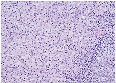 H&E slide (medium magnification, 20×) shows activated lymphocytes, immunoblasts and plasmacytoid monocytes.