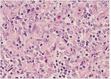 H&E (High power magnification, 40×) shows characteristic large activated lymphoid cells, karyorrhectic debris and histiocytes. The histiocytes are enlarged with crescentic nuclei and phagocytized nuclear debris. Neutrophils are absent.