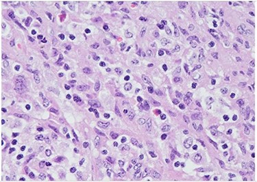 H&E (High power magnification, 40×) shows characteristic large activated lymphoid cells, karyorrhectic debris and histiocytes. The histiocytes are enlarged with crescentic nuclei and phagocytized nuclear debris. Neutrophils are absent.