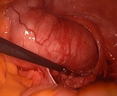 Intraoperative sigmoid and rectum colon tumor.