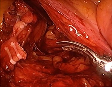 Inferior mesentery artery ligation.