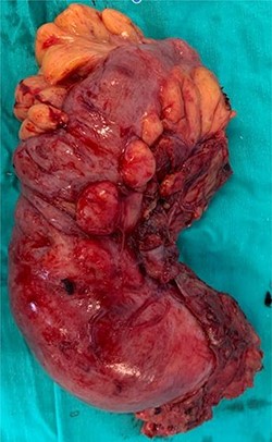 Sigmoid and rectum colon postoperative piece of resection.