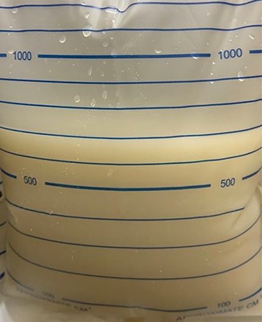 Pelvic drainage with chylous fluid at fifth postoperative day.