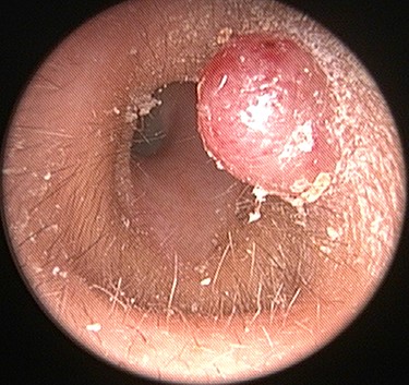 A 0.6 × 0.6 cm, soft, pinkish, cystic mass in the posterior cartilaginous portion of the left external auditory canal.