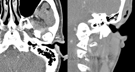 Facial CT revealing an enhanced cystic mass in the posterior cartilaginous portion of the left external auditory canal. (A) Axial view and (B) coronal view.