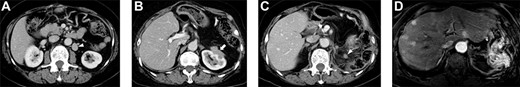 Selected abdominal computed tomography and gadoxetic acid–enhanced magnetic resonance images: Case 1. (A) Recurrence for the first time: para-aortic mass measuring 28 mm located dorsal to the left renal vein (arrowhead). (B) Recurrence for the second time: mass measuring 40 mm invading the left kidney (arrow). (C, D) Recurrence for the third time: mass measuring 12 mm at the same site as that of the second recurrence (c; arrowhead) and multiple liver metastases in the bilateral lobe (d).
