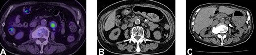 Selected abdominal computed tomography and positron emission tomography–computed tomography images: Case 2. (A) Recurrence for the first time: para-aortic mass measuring 24 mm with accumulation on positron emission tomography (SUVmax: 5.1). (B) Recurrence for the second time: para-aortic mass measuring 15 mm (arrowhead). (C) Recurrence for the third time: para-aortic mass measuring 24 mm (arrow).