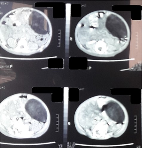 CT scan of the abdomen revealed a fat density mass with defined margins filling the left abdomen and shifting the small bowel to the right.