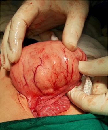 Mass adherent to the bowel and mesentery at exploration.