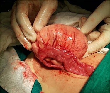 Appearance of the mass at exploration.