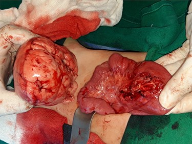 General appearance of the mass after excision.