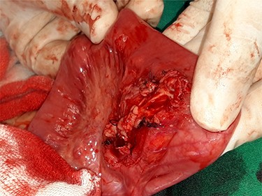 Appearance of the mesentery after the mass’s excision.
