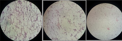 Histopathological examination showed mature fat cells and no cellular atypia.