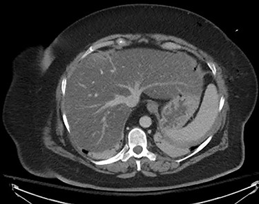 CT thorax and abdomen, infused, immediately post-operative noting severe fatty infiltration within the liver and Veress needle track.