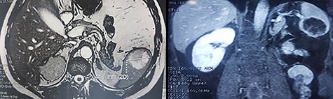 Adominal MRI showing the splenic mass.
