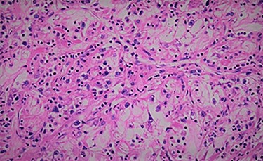 Histology showing clear cell from renal carcinoma.