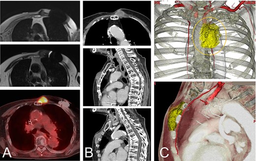 An 82-year-old woman with a malignant spindle cell sarcoma in the superficial chest wall. The MRI shows a lesion involving the anterior sternum on the left side with low-to-intermediate signal intensity on T1- (A-top) and T2-weighted images (A-middle) with a high SUVmax on FDG-PET (A-bottom). CT with contrast medium depicted the lesion (B). The lesion involved not only the anterior sternum (B-top and -middle), but also the intercostal space (B-bottom). The cut line (orange line) is drawn with a yellow line. The internal thoracic artery runs under the tumor and the vessels were resected together (C).